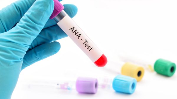 Understand the ANA test to understand when you need a rheumatologist