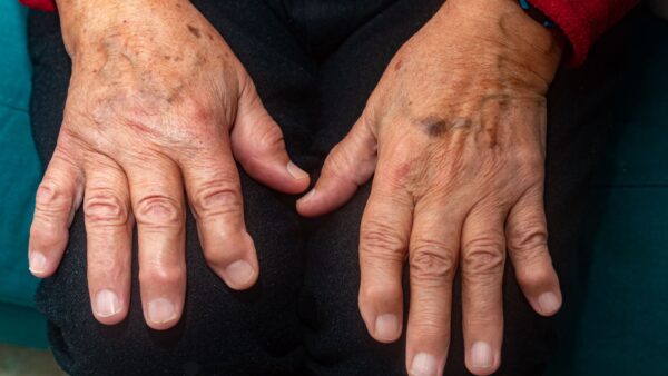 Erosive Osteoarthritis is a severe form of arthritis that impacts the hands